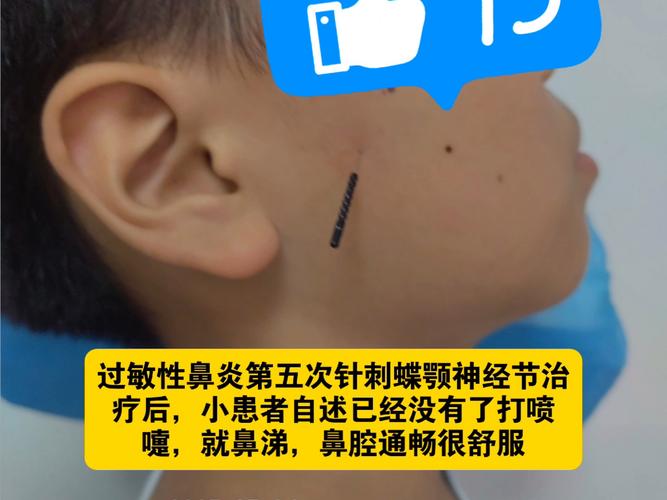 鼻刺是什么