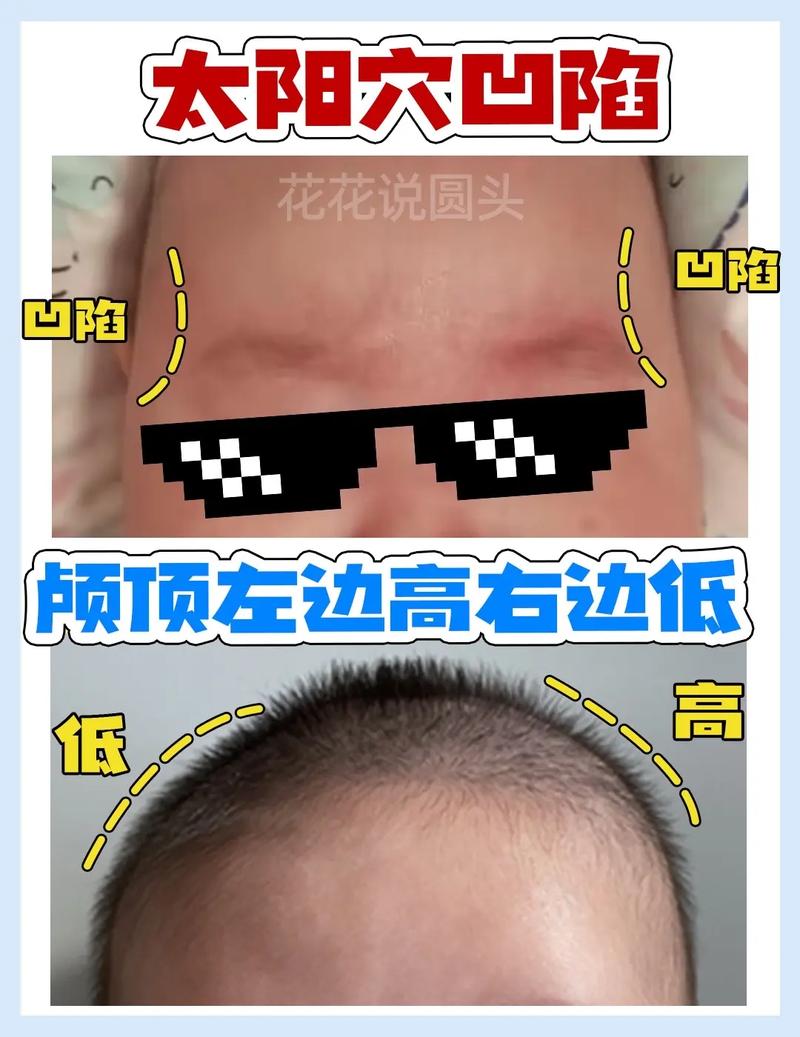 什么是额头低
