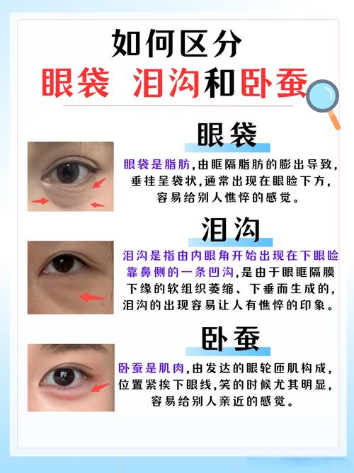 什么是眼袋什么是泪沟