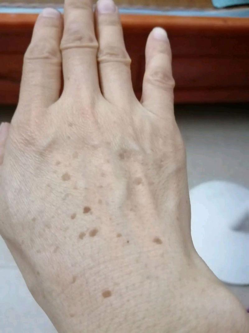 手背长斑是什么原因