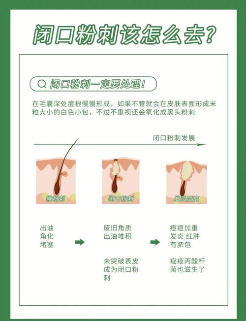 长闭合粉刺是什么原因
