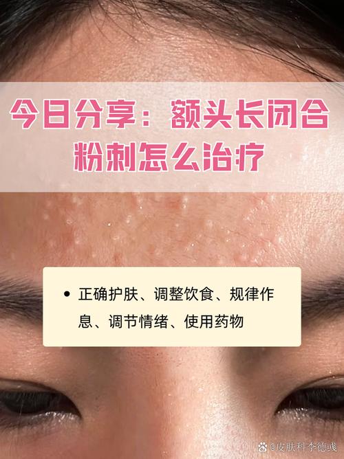 长闭合粉刺是什么原因