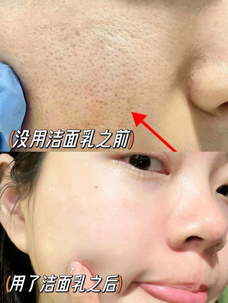 用新的洗面奶起痘痘怎么回事