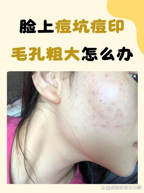 用洗面奶起痘痘怎么回事