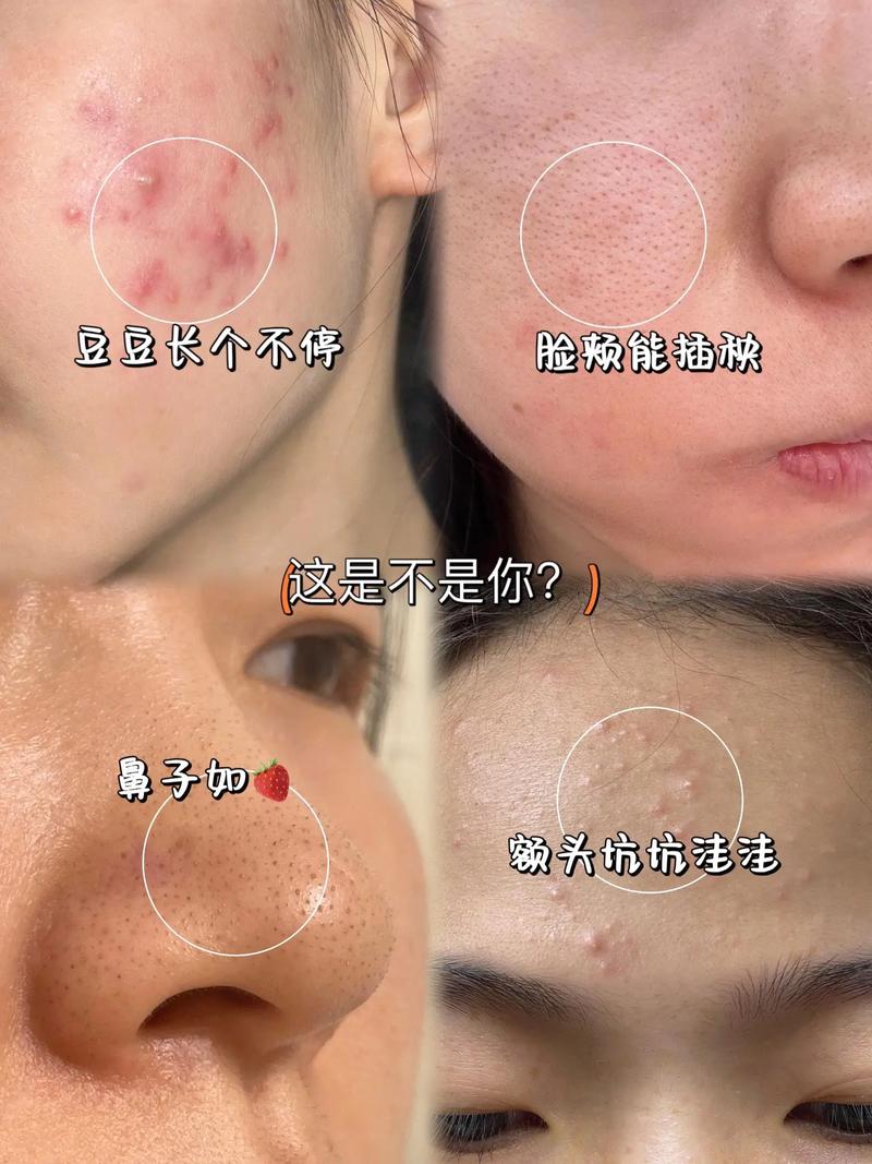 用洗面奶起痘痘怎么回事