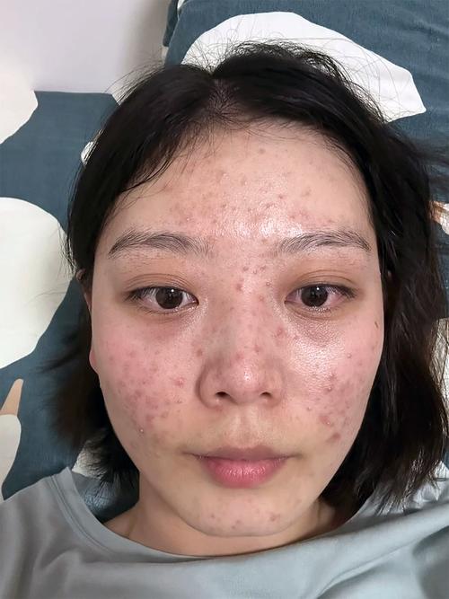 洗面奶用过起痘痘怎么回事