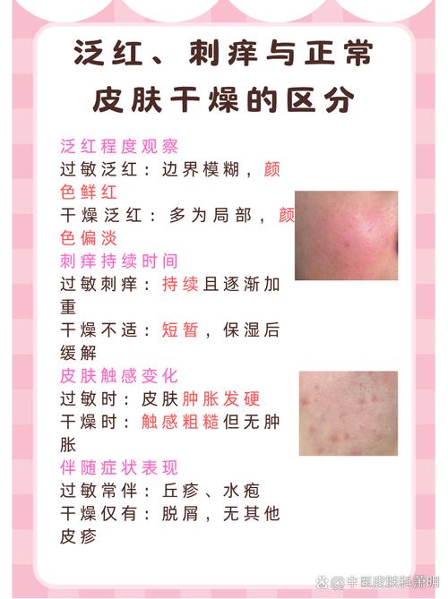 脸上过敏什么不能吃