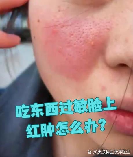 脸上过敏什么不能吃