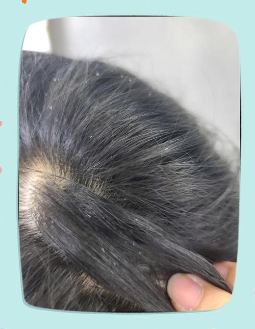 头发上白白的是什么