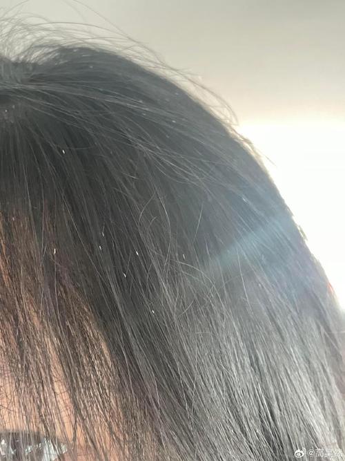 头发上白白的是什么