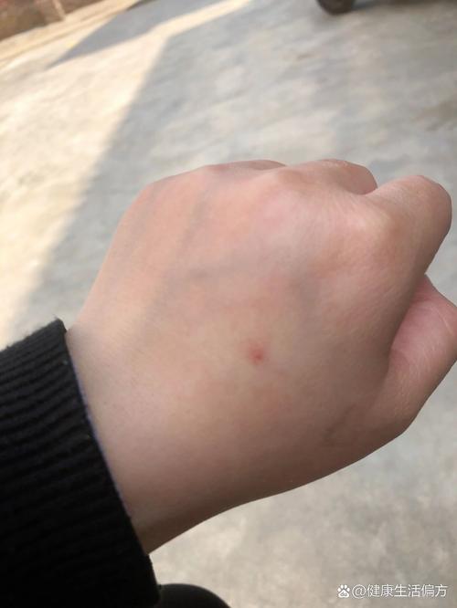 蜘蛛痣长什么样子