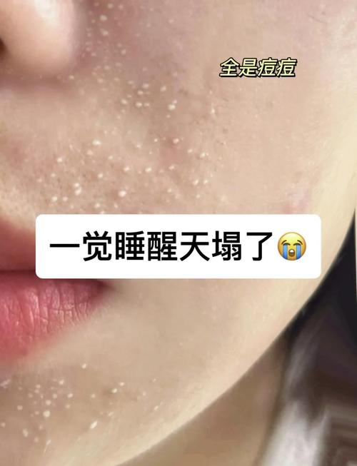 为什么洗完洗面奶长痘痘怎么回事啊