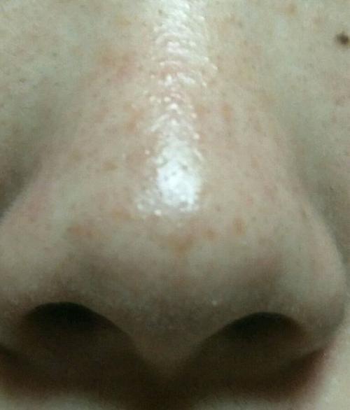 酒糟鼻什么样子