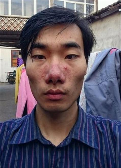 酒糟鼻什么样子