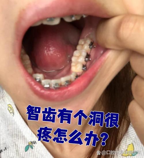 为什么智齿容易坏