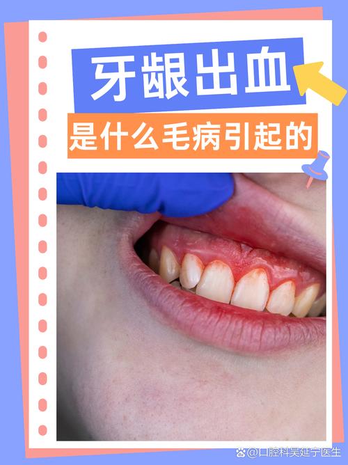 为什么牙齿经常出血