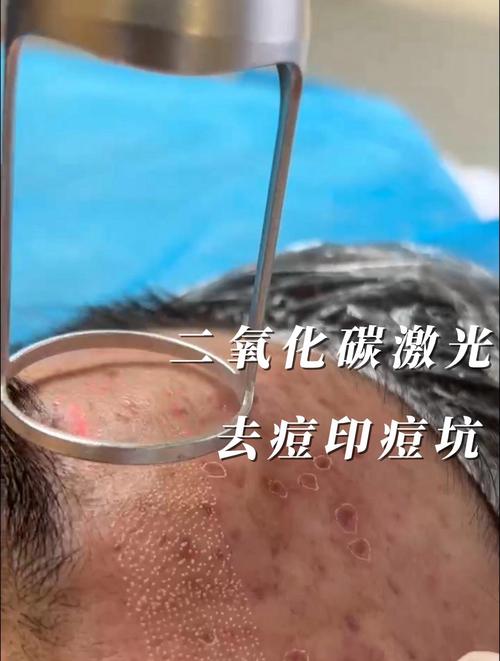 什么是激光祛痘