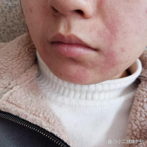 换洗面奶脸过敏怎么办
