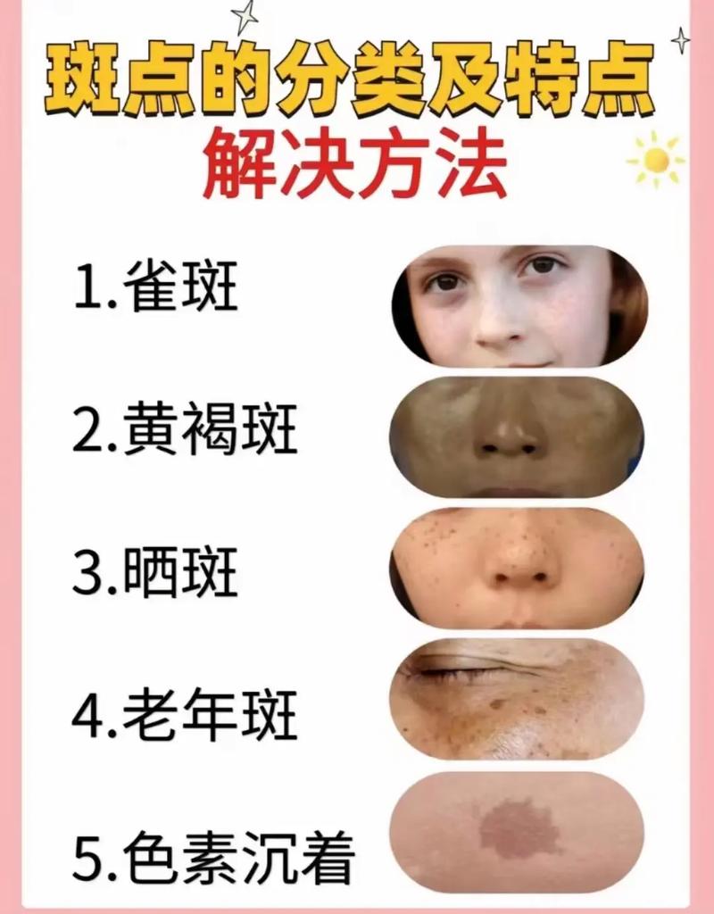 脸上为什么有雀斑