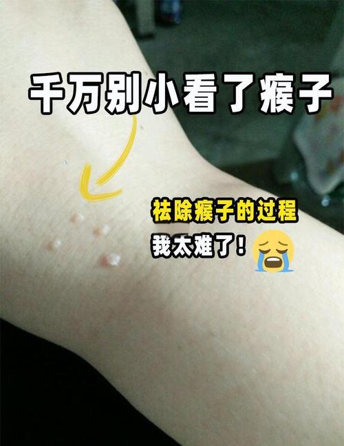什么是刺瘊
