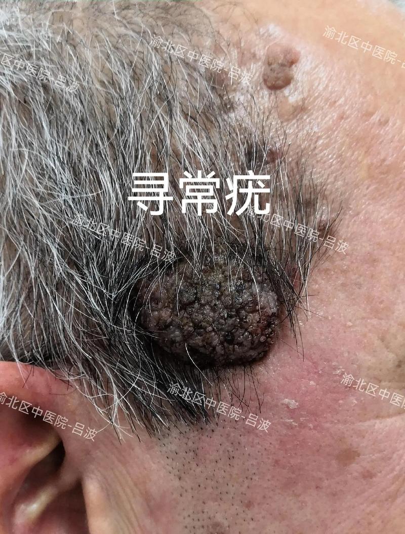 什么是刺瘊