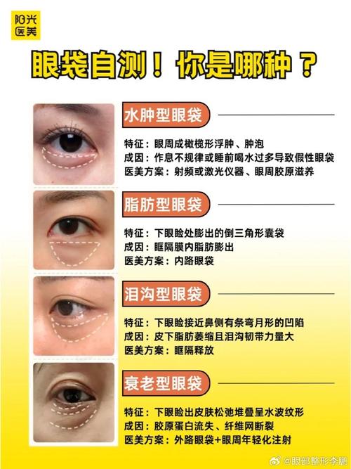 什么方法消除眼袋