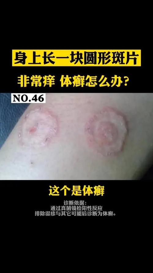 为什么会得体癣