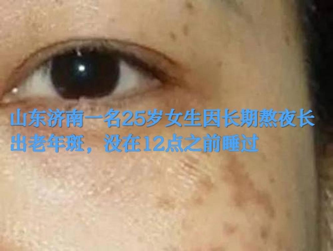 熬夜为什么会长斑