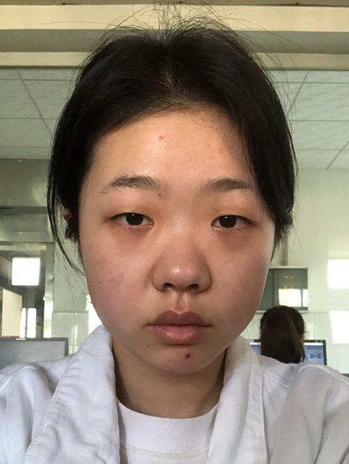 单眼皮为什么不好看