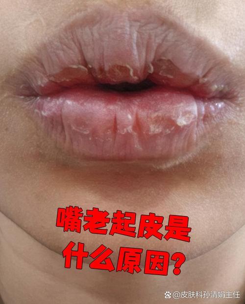 嘴唇爆皮是什么原因