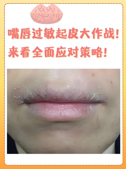 嘴唇爆皮是什么原因