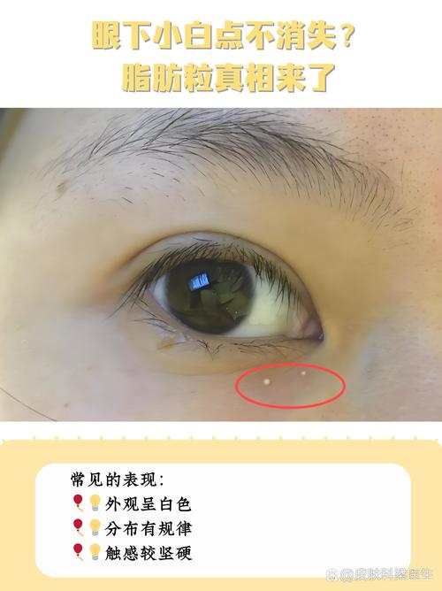 为什么眼皮长脂肪粒