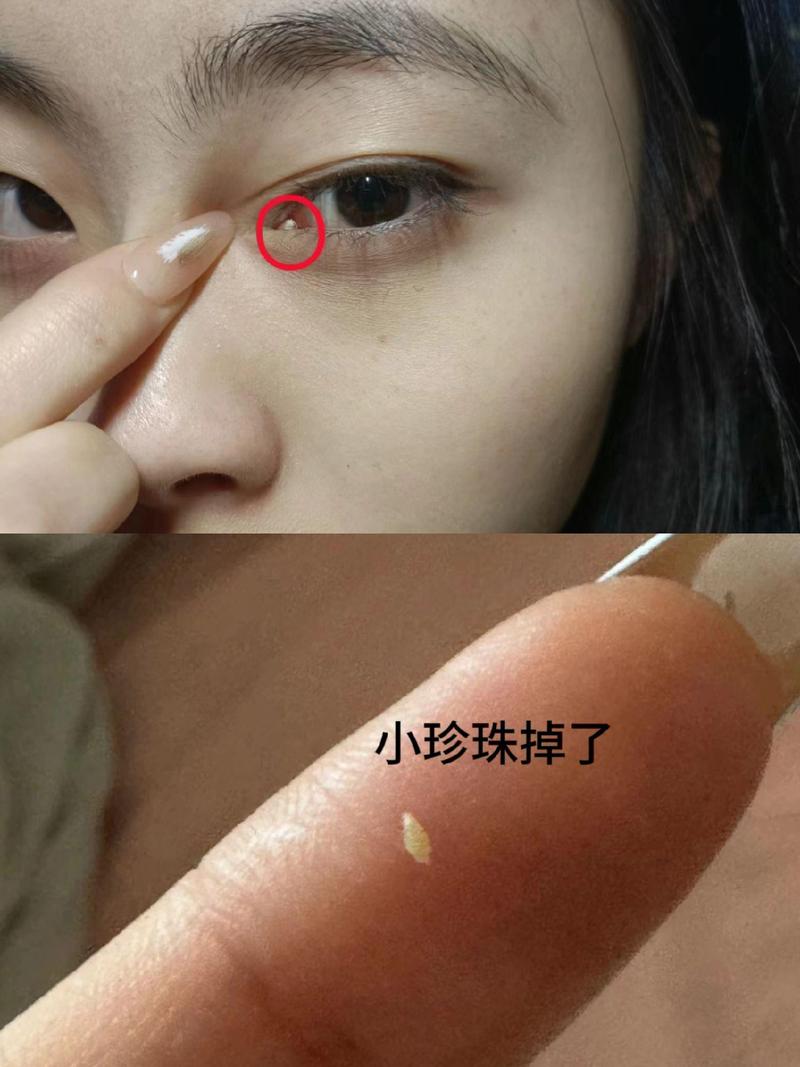 为什么眼皮长脂肪粒