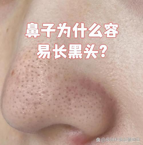 为什么鼻子长黑头
