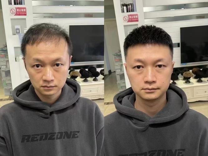 头发稀少看什么科