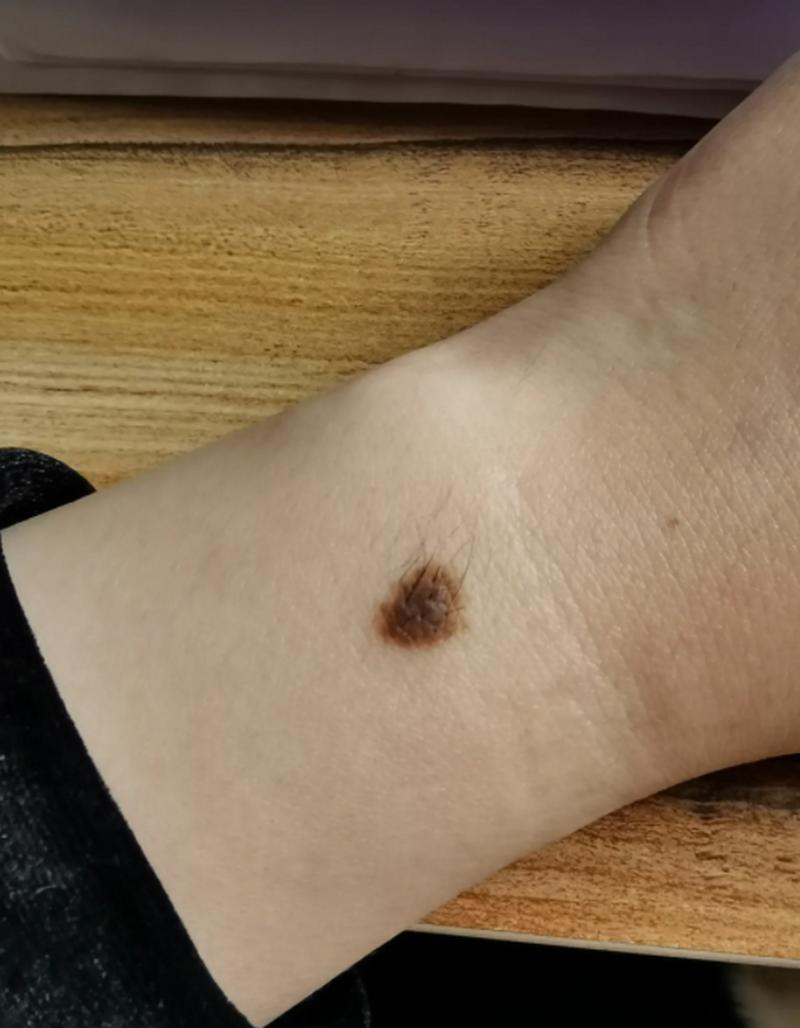 什么是黑毛痣