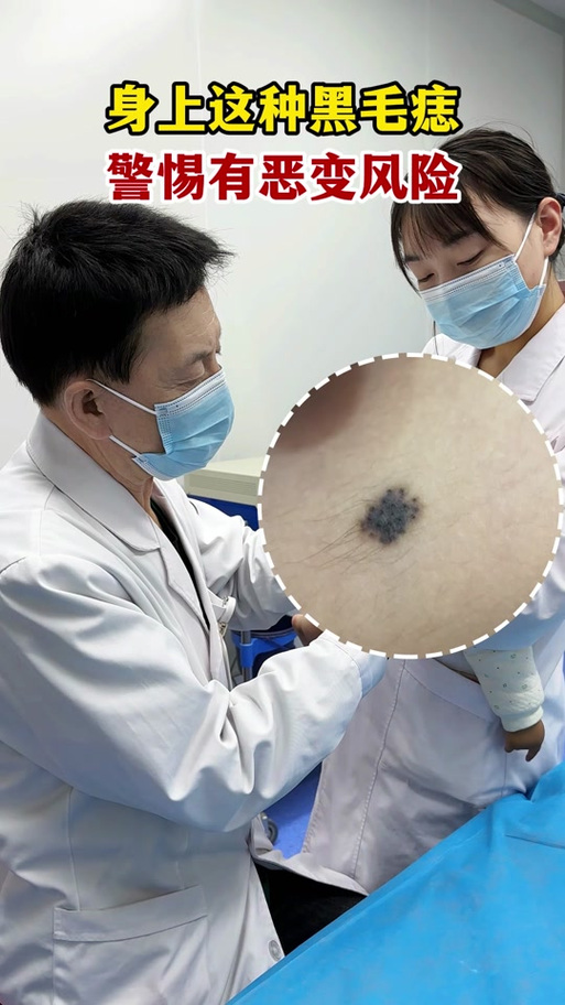 什么是黑毛痣