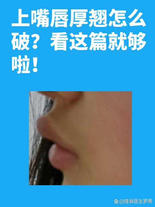嘴唇厚是为什么