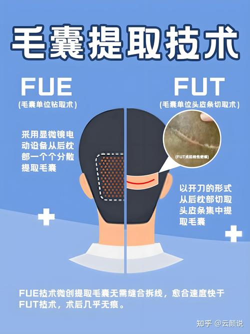 什么是植发手术