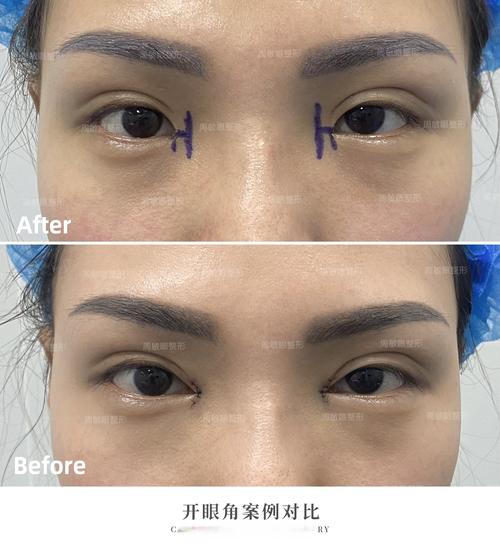 开眼角是什么手术
