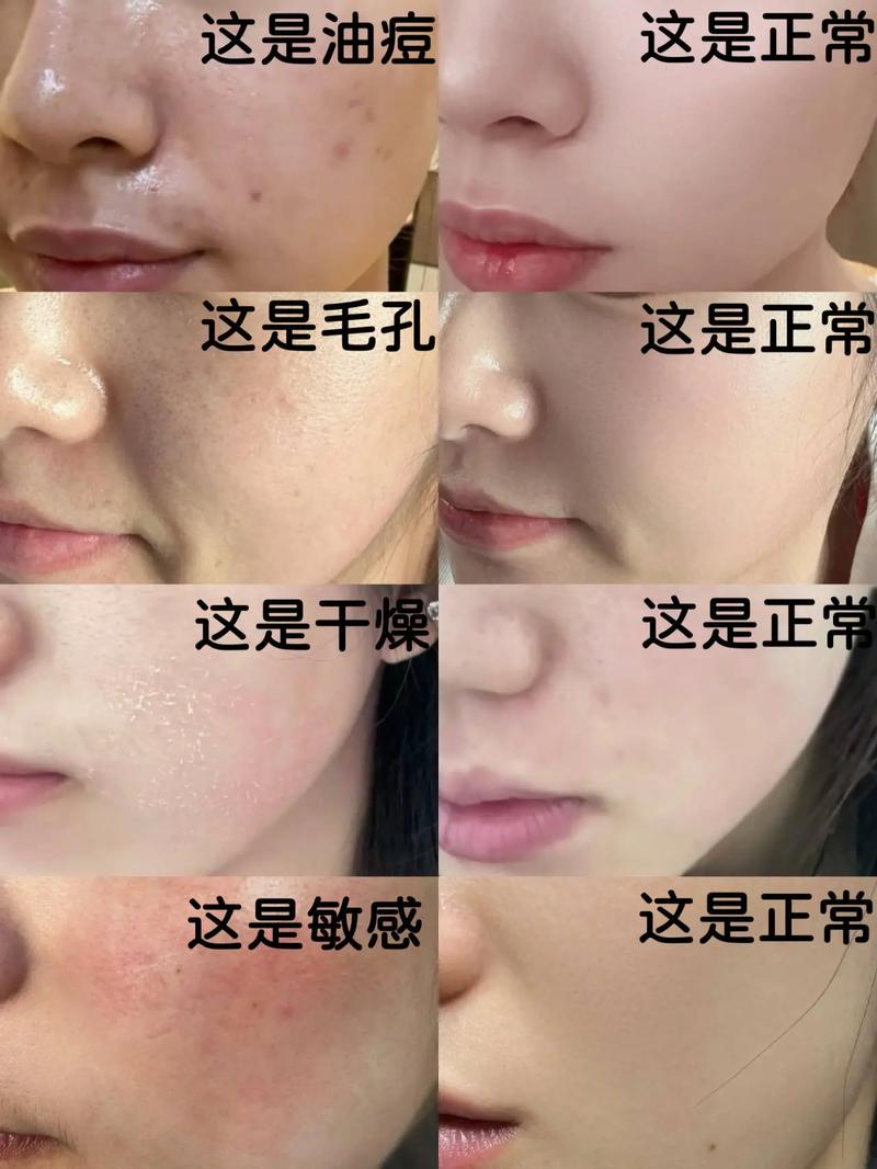 用了洗面奶长痘怎么办