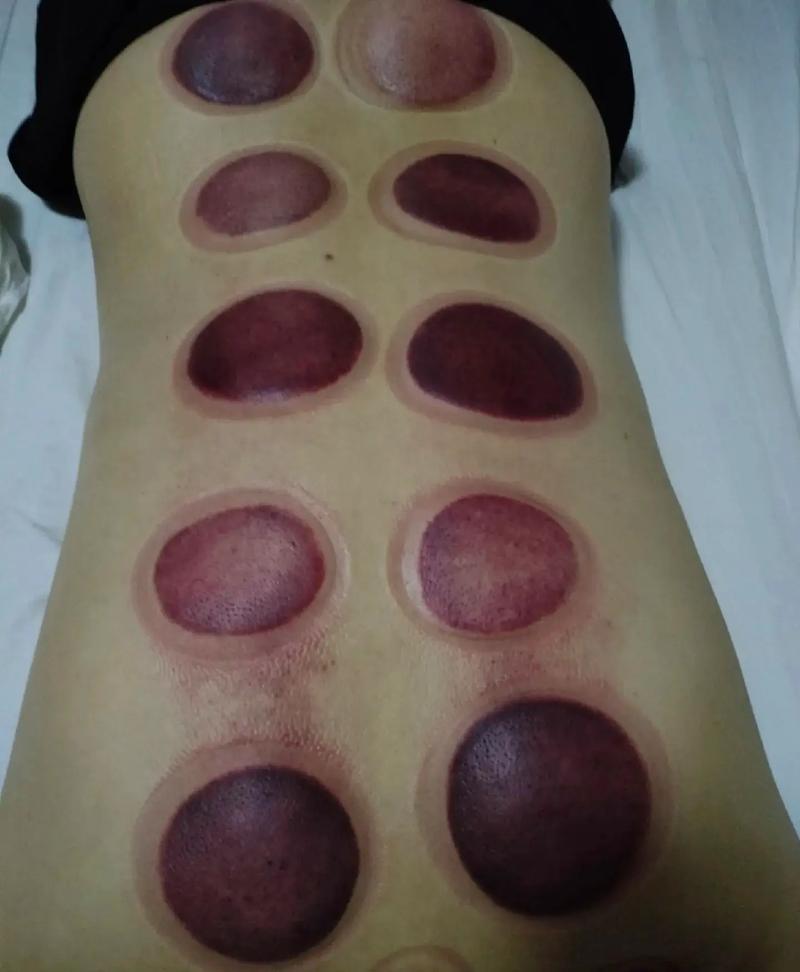 后背拔什么罐能减肥