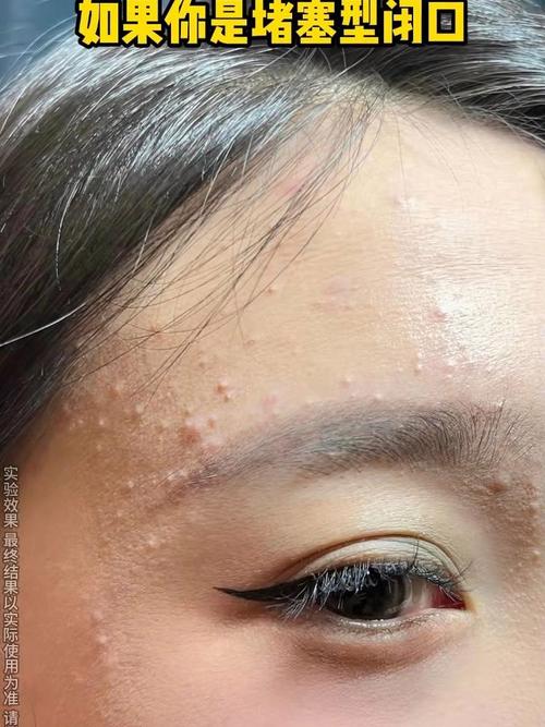洗面奶洗了痘痘发红怎么回事