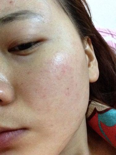 洗面奶洗了痘痘发红怎么回事