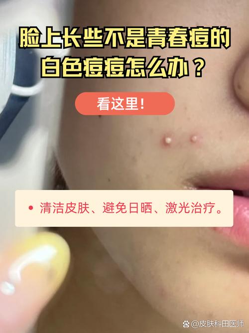 痘痘里面白色的是什么
