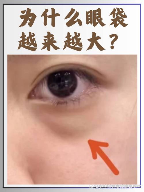 眼袋深是什么原因