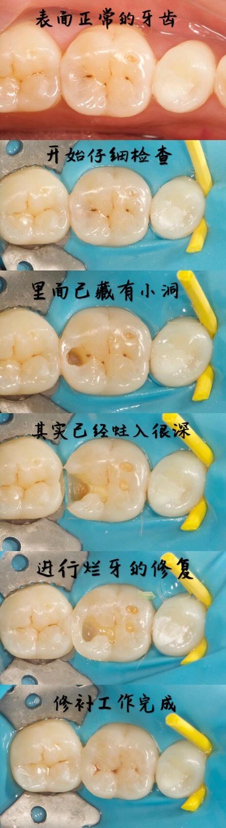 牙齿上的黑点是什么