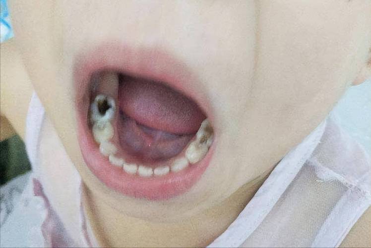 牙齿上的黑点是什么
