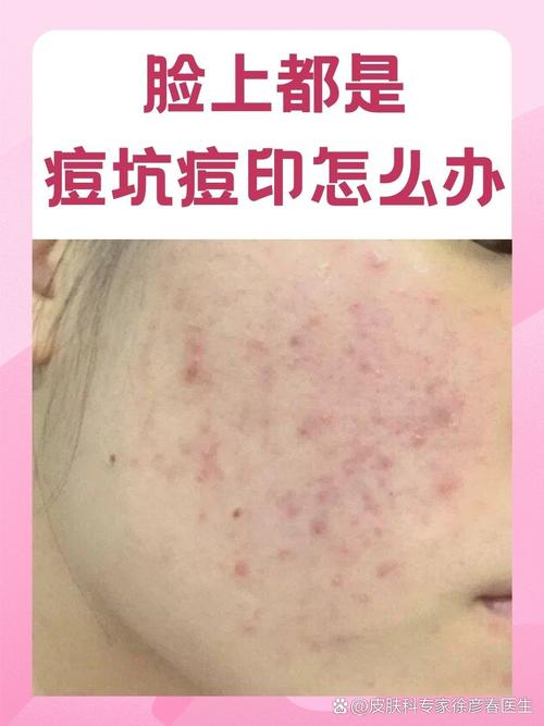 脸上为什么会有痘印