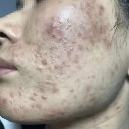 脸上为什么会有痘印